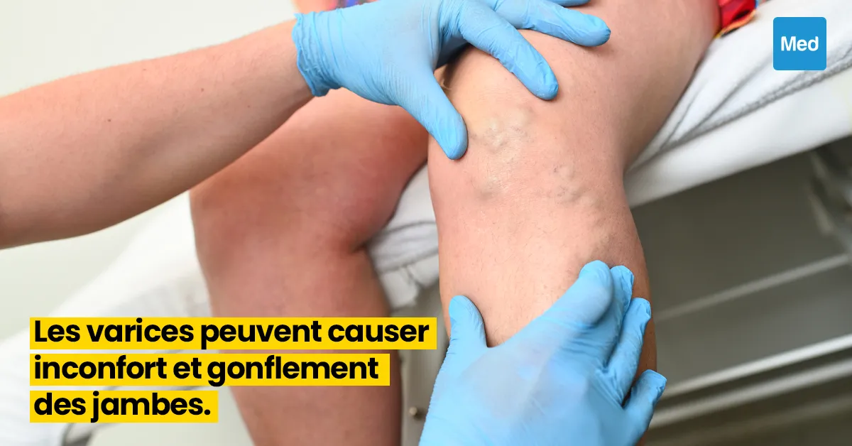 Comprendre et Gérer les Varices : Causes, Symptômes et Solutions